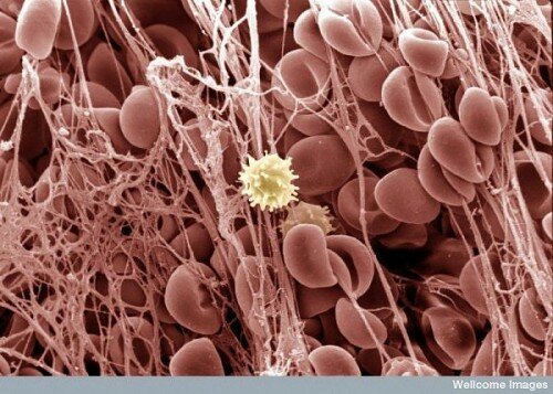 Human Body Microscopic Picture - Blood Clot with White Blood Cell Human Body Microscopic Picture - Blood Clot with White Blood Cell