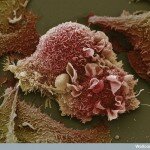 Human Body Microscopic Picture - Lung Cancer Cell